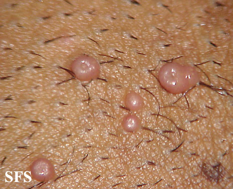 Molluscum_Contagiosum7.jpg