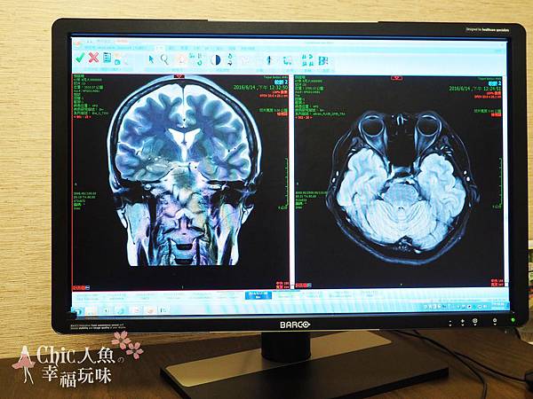 北投健康管理醫院-MRI當日報告醫師解說 (6)