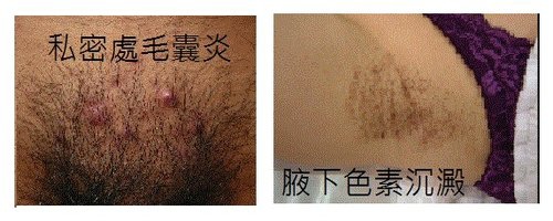除毛看這裡 情趣生活很重要 光溜溜的美腿總是讓男人神魂顛倒 毛茸茸的腿 總是讓男人退避三舍 千萬別小看毛髮的威脅 過於濃密的私密 處可是會令人倒胃口 蓓爾黛專業雷射除毛診所 讓你生活更有情趣更幸福