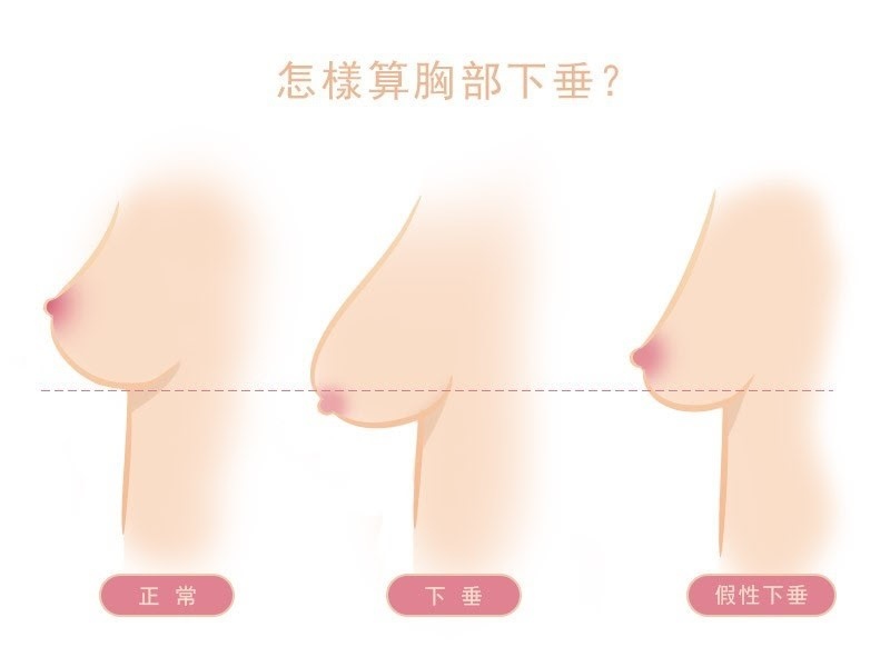 【高雄隆乳】產後胸部下垂,是真的下垂還是假性下垂?隆乳就能改善嗎?|高雄群英整形外科診所.jpg 胸部下垂/假性下垂/真下垂.jpg
