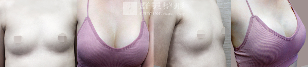 產後隆乳-01.jpg 產後隆乳-01.jpg