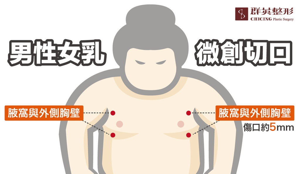 男性女乳手術切口.jpg 男性女乳手術切口.jpg