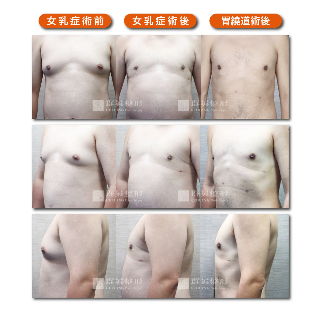 男性女乳-台中群英.jpg 男性女乳-台中群英.jpg
