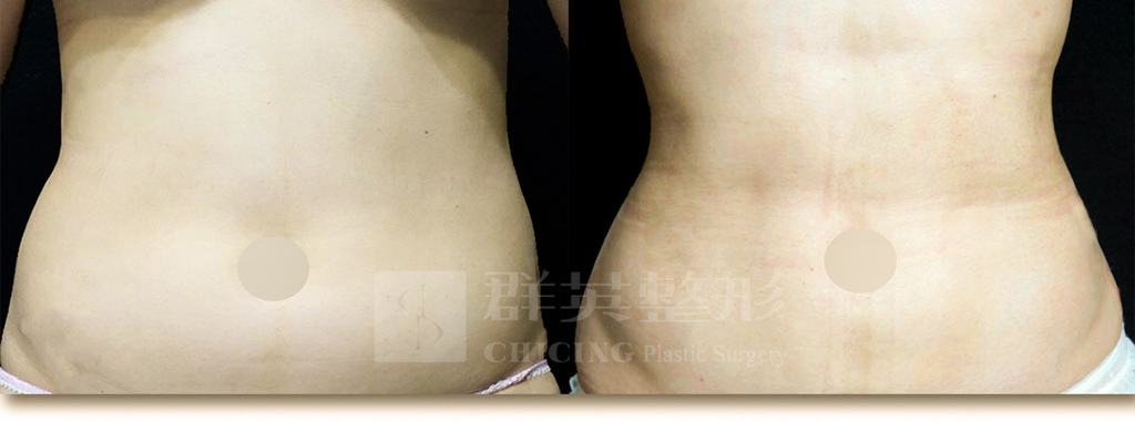 腹部抽脂.jpg 腹部抽脂.jpg