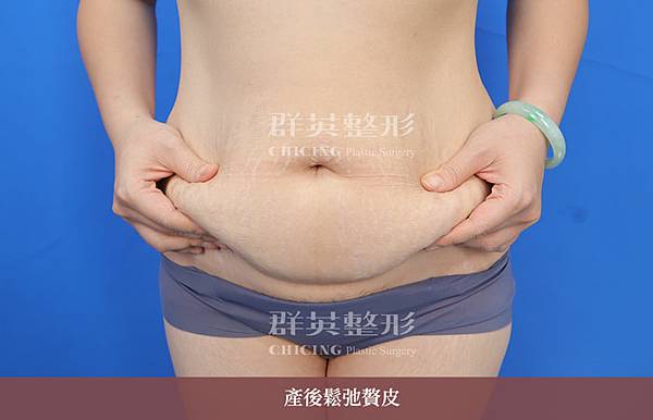 【台中腹部整形】產後肚皮鬆弛下垂，腹部拉皮＋腹部抽脂真實案例