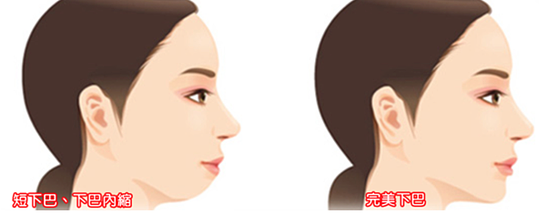 如何判斷暴牙矯正完後臉型的變化 林榆芩醫師 痞客邦 如何判斷暴牙矯正完後臉型的變化 林榆芩醫師 痞客邦