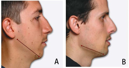 圖二A clockwise rotation of mandible copy