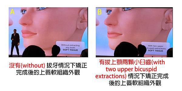 圖一without and with extractions lip profile copy