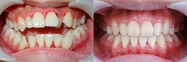 涂薏晴occlusion frontal view