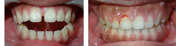 吳佩穎矯正前後正面咬合照