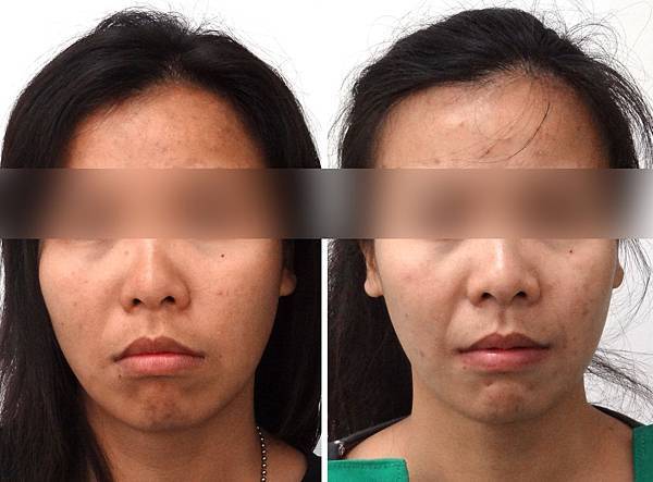 如何判斷暴牙矯正完後臉型的變化 林榆芩醫師 痞客邦 如何判斷暴牙矯正完後臉型的變化 林榆芩醫師 痞客邦
