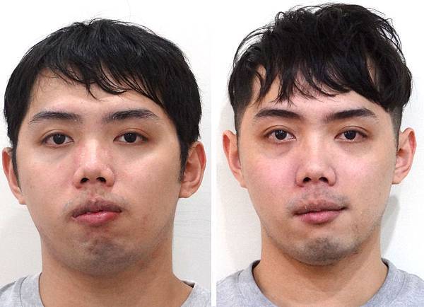 如何判斷暴牙矯正完後臉型的變化 林榆芩醫師 痞客邦 如何判斷暴牙矯正完後臉型的變化 林榆芩醫師 痞客邦