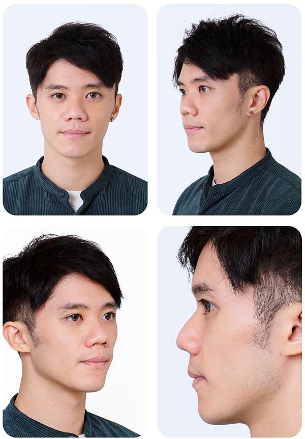 改造天生蓮霧鼻圓夢型男完美鼻例 三段式自軟骨隆鼻圓夢大使 Derek 案例分享 台北隆鼻手術推薦徐典雄醫師高全祥醫師 改造天生蓮霧鼻圓夢型男完美鼻例 三段式自軟骨隆鼻圓夢大使 Derek 案例分享 台北隆鼻手術推薦徐典雄醫師高全祥醫師