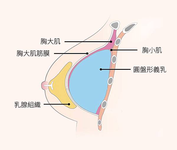 台北隆乳女醫師 晶華美醫診所 複合式隆乳 魔滴隆乳 內視鏡果凍矽膠隆乳