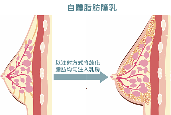 台北隆乳女醫推薦,自體脂肪隆乳方式