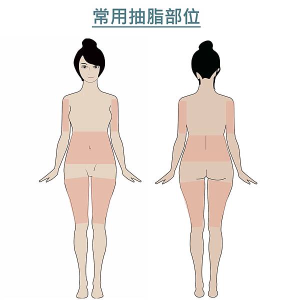 晶華美醫醫美診所,台北隆乳女醫師,常見抽脂部位