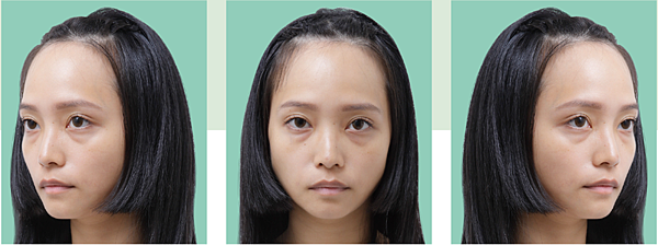 來晶華醫美進行隱痕眼袋、蘋果肌補脂前，有眼袋淚溝、臉部凹陷困擾