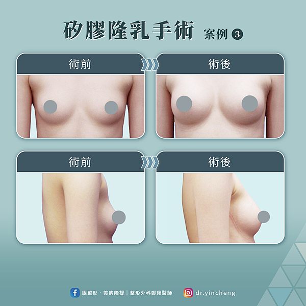 有任何隆乳手術需求，歡迎至台北桃園晶華醫美預約諮詢。