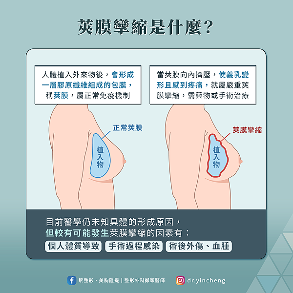 目前醫學還無法明確指出隆乳後莢膜攣縮的發生原因。