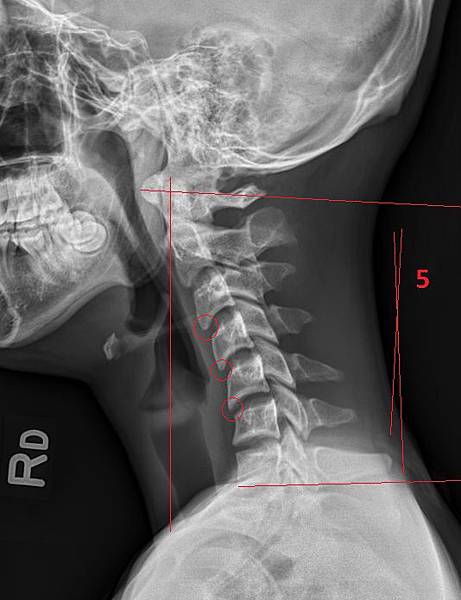 kyphotic cervical curve