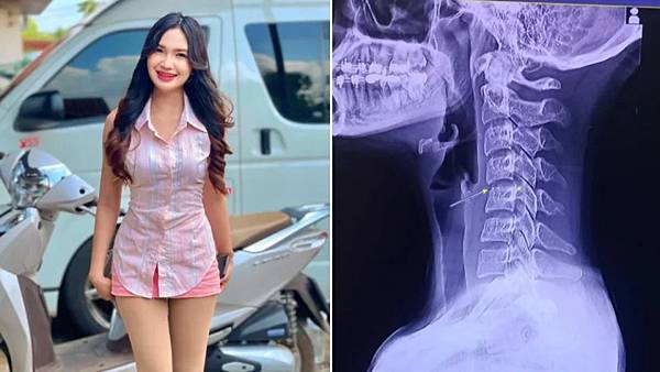 泰國女歌手事件另有真相？頸椎扭轉與真菌感染的背後可能