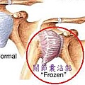 frozen-Shoulder1.jpg