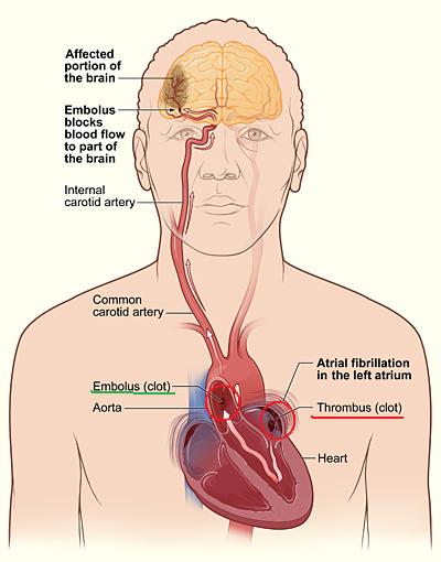 atrial_fib_stroke.jpg