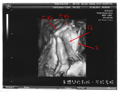 25w+4d