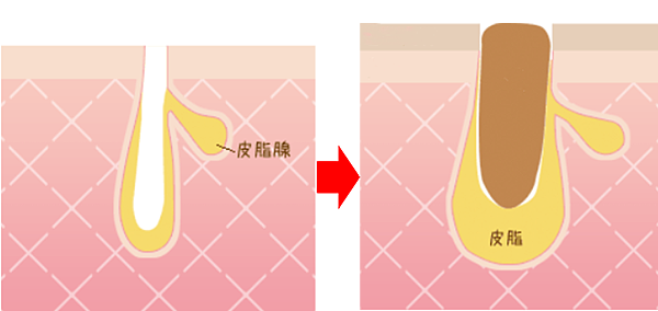 形成粉刺.png 形成粉刺.png
