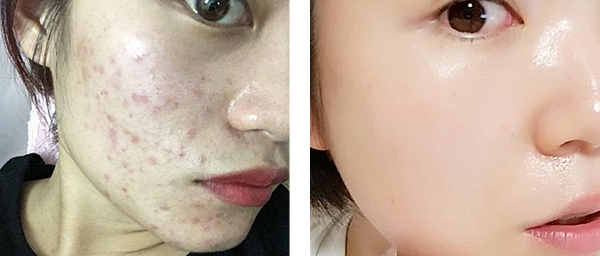 痘痘肌對比.png 痘痘肌對比.png