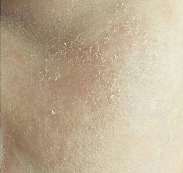 臉乾燥脫皮.jpg 臉乾燥脫皮.jpg