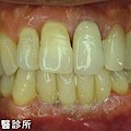 B-人工植牙術前術後-2