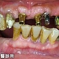 D-人工植牙術前術後-1