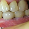 D-人工植牙術前術後-3