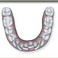 齒顎矯正-3-牙齒擁擠