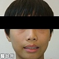 B-齒顎矯正術前術後-2