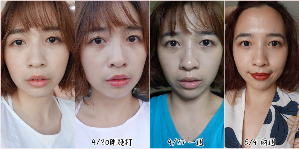 Q+音波拉提-輕熟女的午間保養~29歲小心了!地心引力已經悄悄的在拉垮你的臉!
