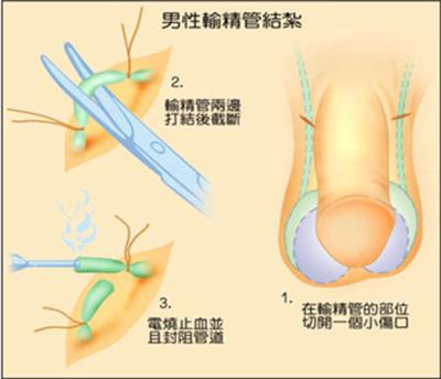 基督徒應該把節育手術視為可行的節育方法嗎 Christian 痞客邦 基督徒應該把節育手術視為可行的節育方法嗎 Christian 痞客邦