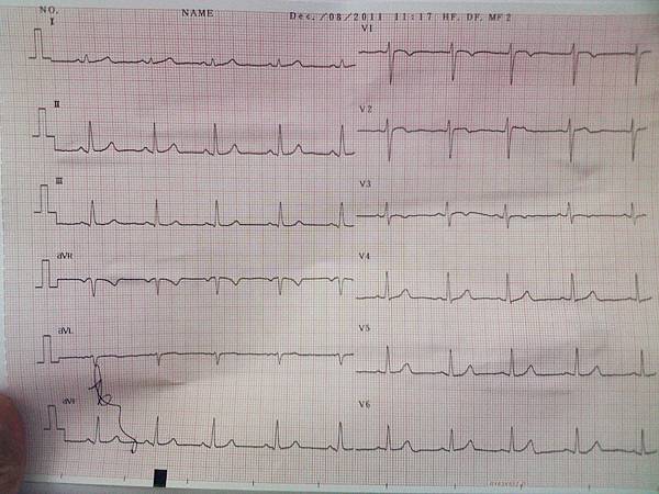 心電圖02-20111208.JPG