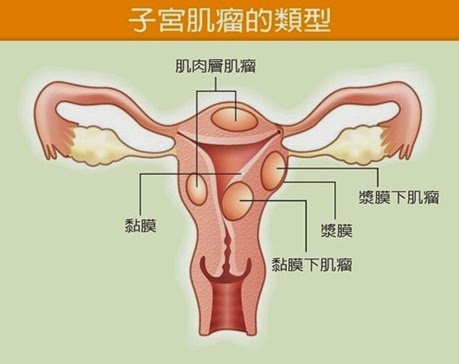 子宮肌瘤.jpg