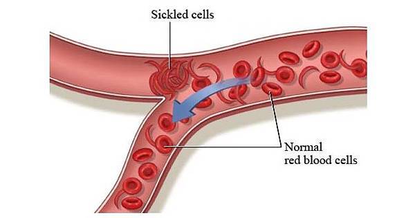 鐮刀血管阻塞.jpg