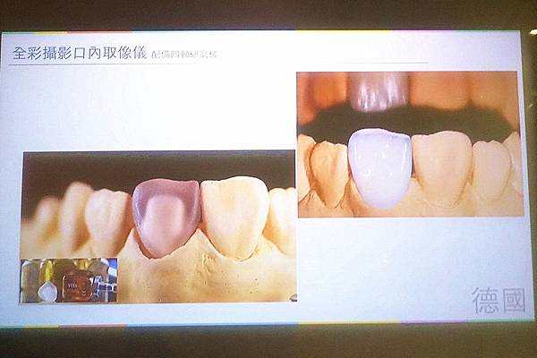 悅庭牙醫3D數位全瓷牙冠