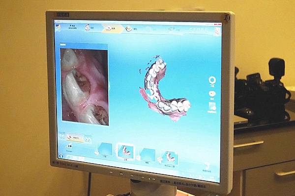 悅庭牙醫3D數位全瓷牙冠