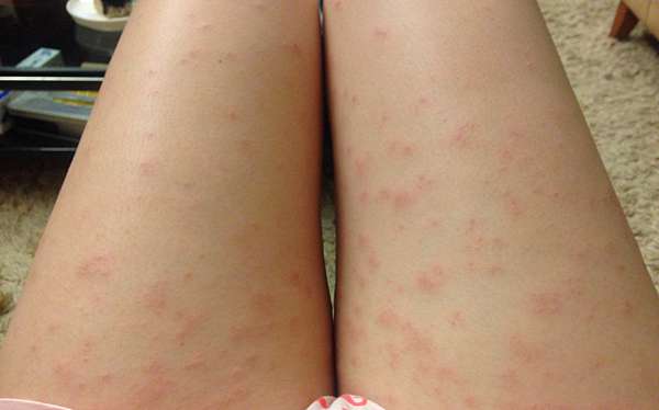 孕媽咪記事1 12週 痛苦的妊娠蕁麻疹 克萊兒與小朔的隨想日誌 痞客邦