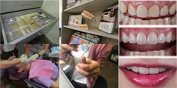 擷取.JPG 一日全瓷冠-瓷牙貼片-全瓷冠假牙-悅庭牙醫