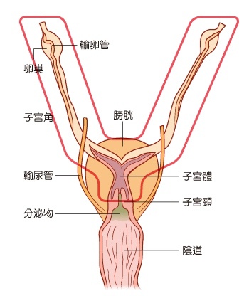 子宮卵巢摘除術.jpg