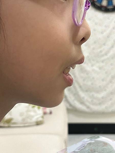 張口呼吸鼻塞是因為腺樣體肥大