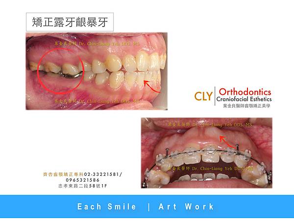 CLY Orthodontics Studio | 齊杏歯顎矯正專科:: 痞客邦::