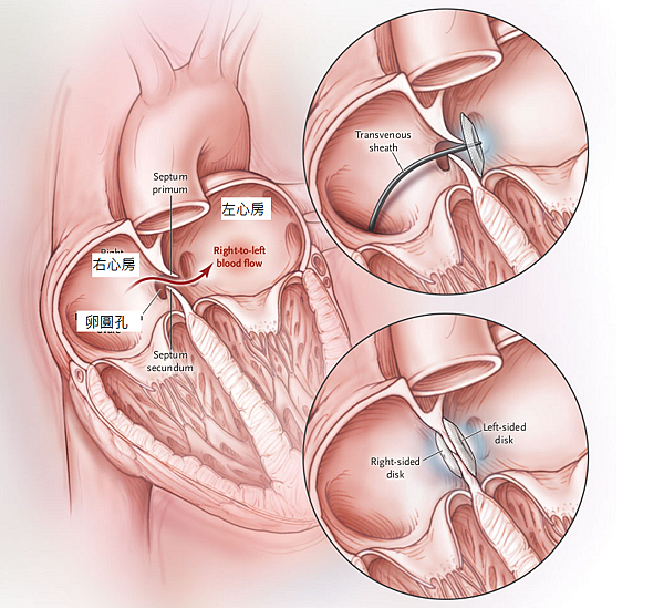 transcatheter_closure_PFO