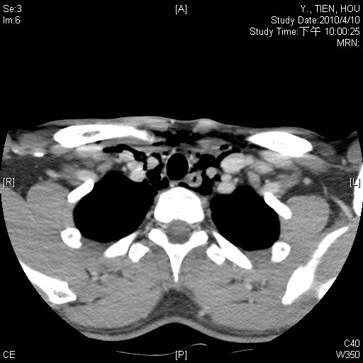 pneumomediastinum 1.jpg